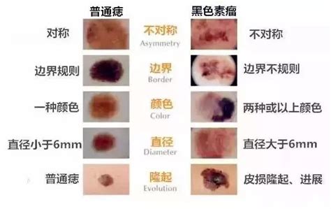 痣的顏色|痣是什麼？會變成黑色素瘤？7種一定要除的痣